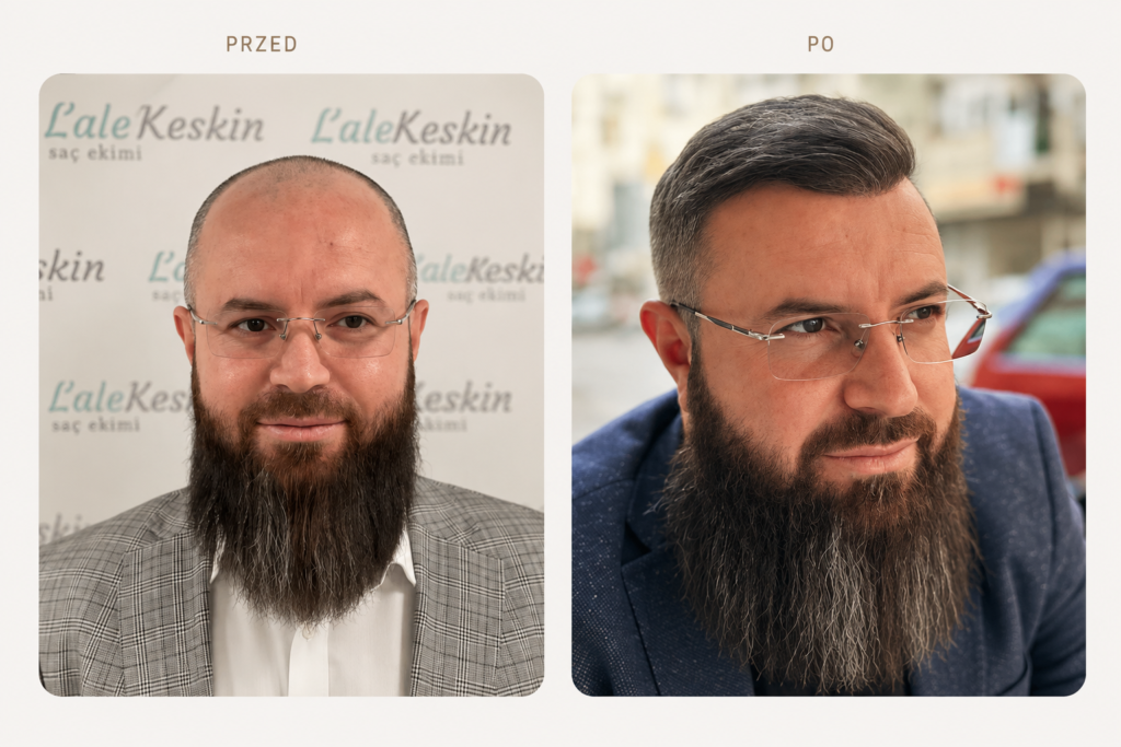 przeszczep włosów śląsk